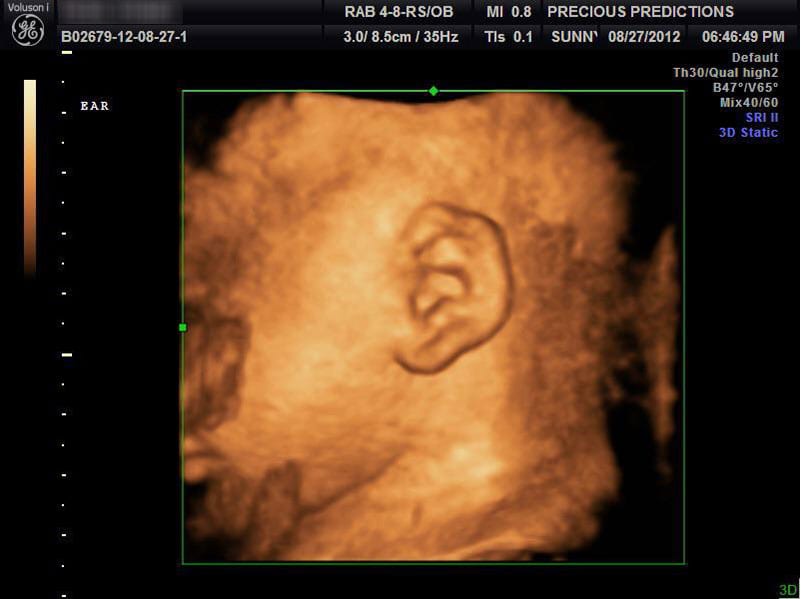 Ultrasound - Pregnancy - Gallery